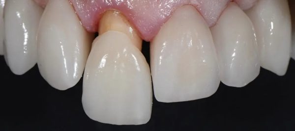 Các dấu hiệu cho thấy bạn cần phải thay răng sứ sau thời gian sử dụng