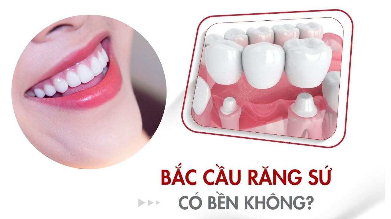 Bắc cầu răng sứ có bền không? 4 yếu tố quyết định tuổi thọ