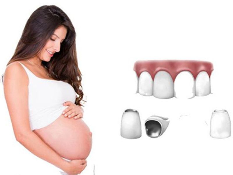 Các phương pháp trồng răng an toàn cho bà bầu