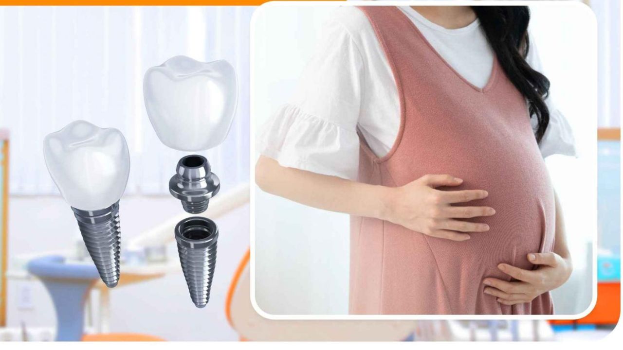 Bà bầu có được trồng răng không? Cần lưu ý khi trồng răng