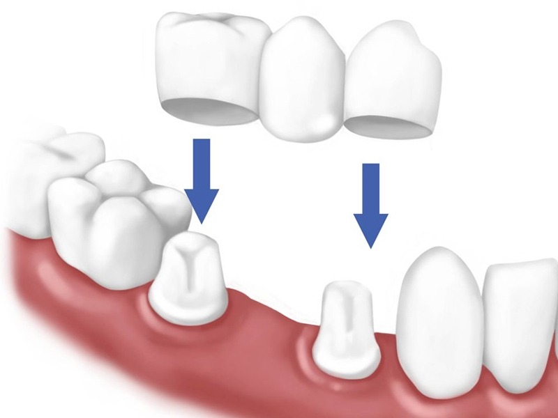  Bắc cầu răng sứ có độ bền trung bình từ 7–15 năm và có thể kéo dài đến 20 năm