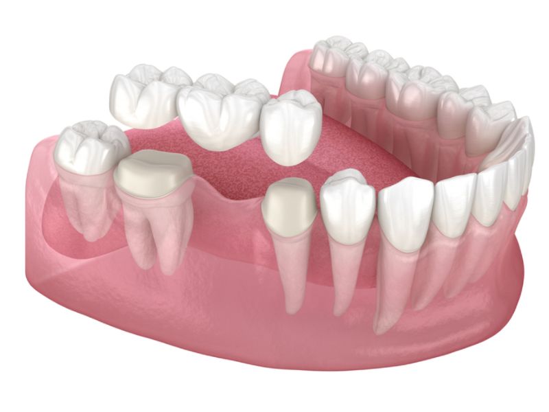 Các yếu tố ảnh hưởng tới độ bền cầu răng sứ