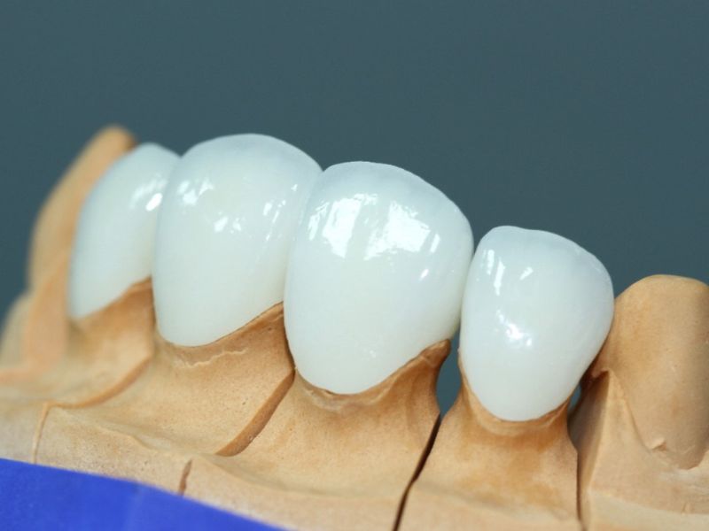 Bảng giá răng sứ Emax dao động từ 5.500.000 - 9.000.000đ/răng