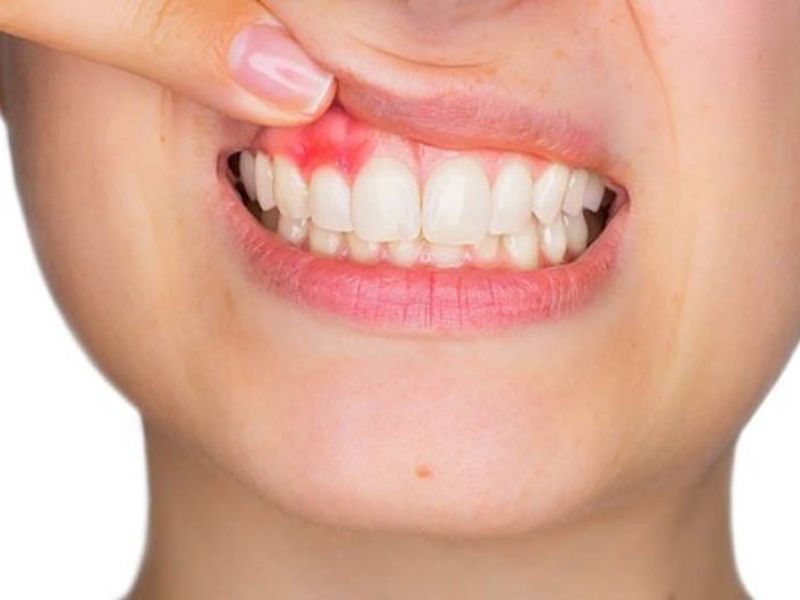 Nha chu là tình trạng viêm nhiễm mạn tính ở mô nâng đỡ răng bao gồm nướu, dây chằng nha chu và xương ổ răng.