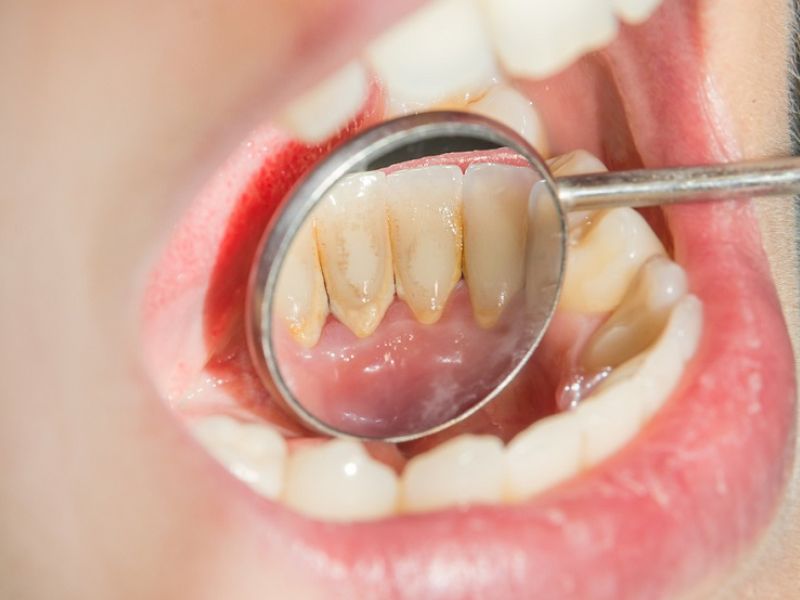 Vẫn có thể bọc răng sứ sau khi điều trị nha chu dứt điểm