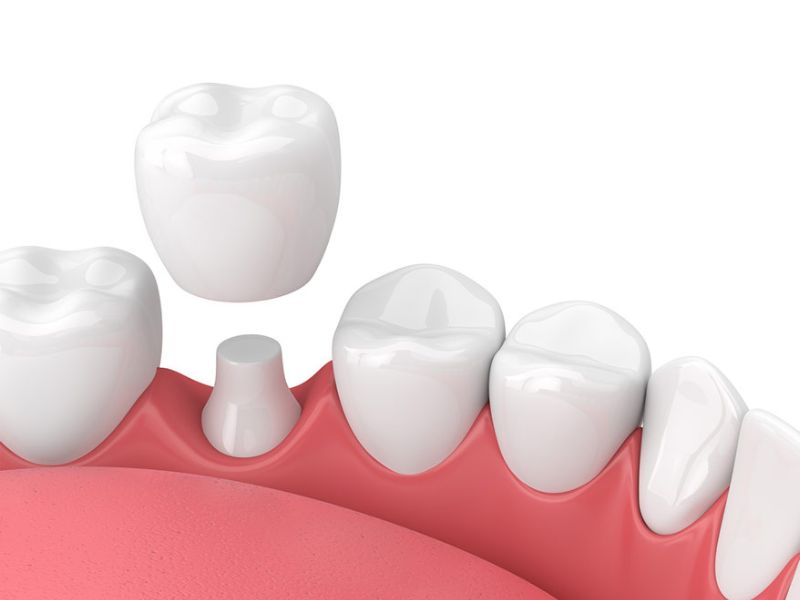 Quy trình bọc răng sứ sau khi điều trị nha chu 