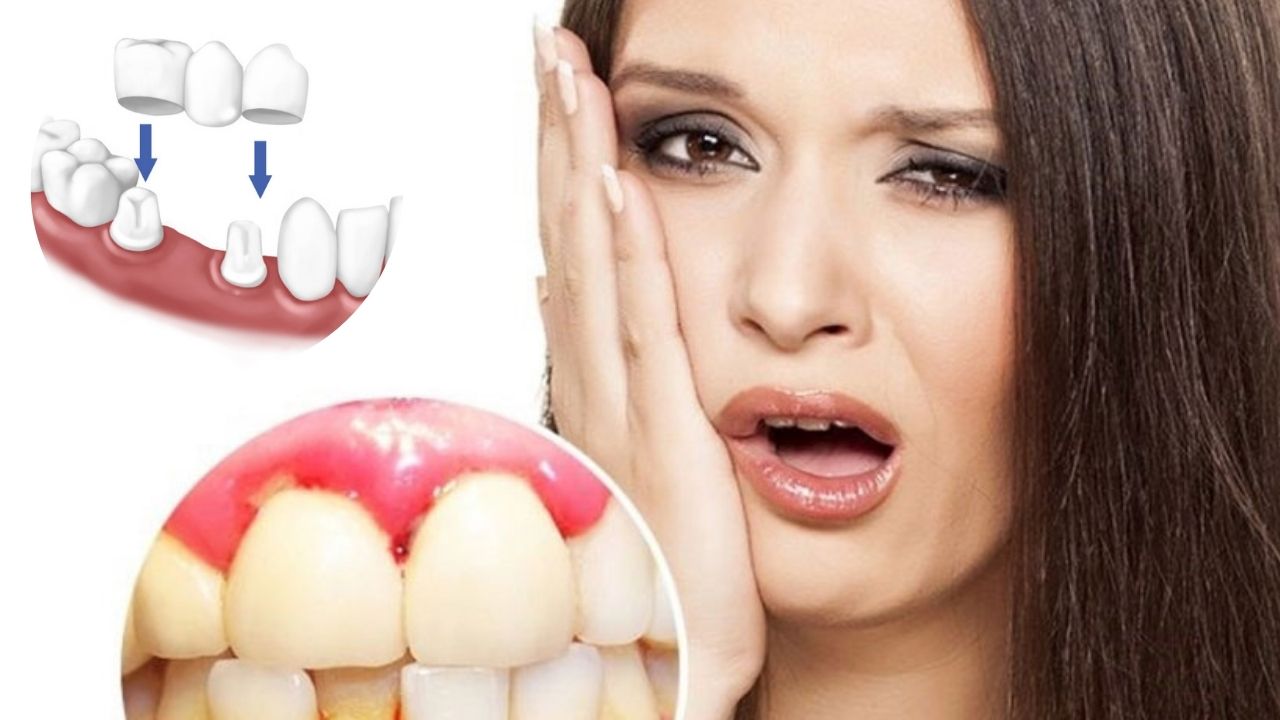 [Giải đáp]Bị nha chu có bọc răng sứ được không?