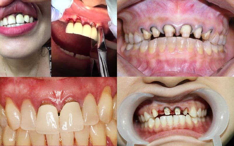 Các biến chứng sau khi bọc răng sứ