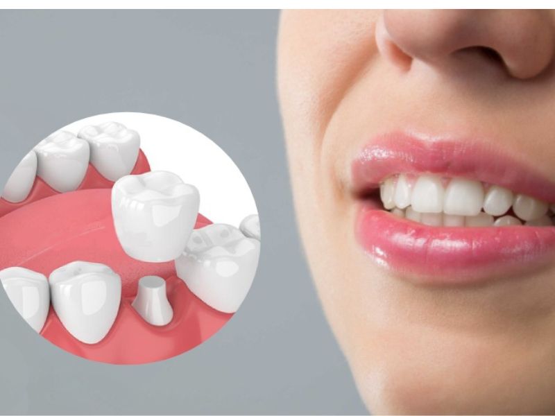 Nguyên nhân gây biến chứng sau bọc răng sứ