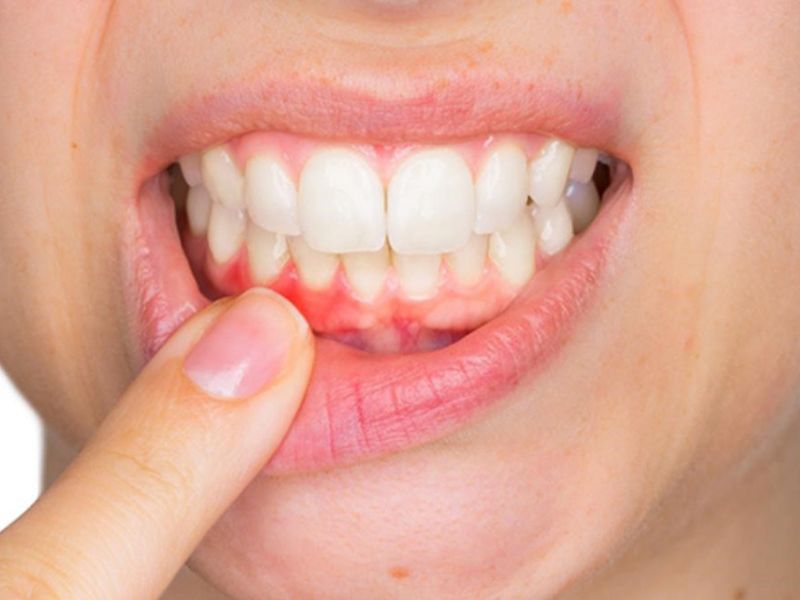Bọc răng sứ bị đau nướu là một dấu hiệu bất thường