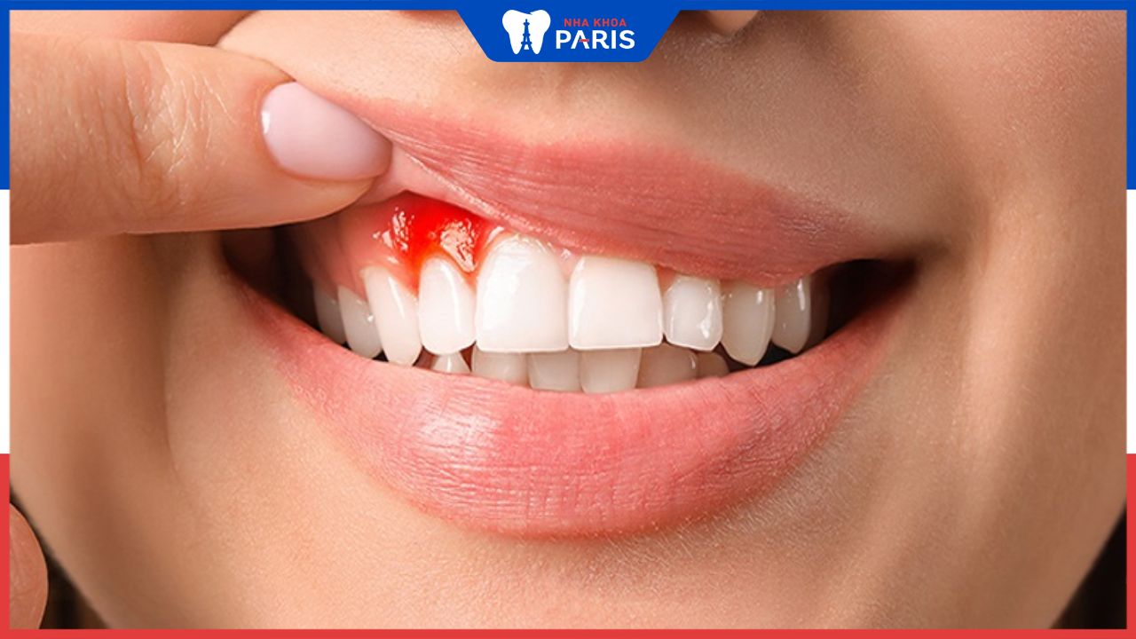 Bọc răng sứ bị đau nướu ? một số điểm cần lưu ý