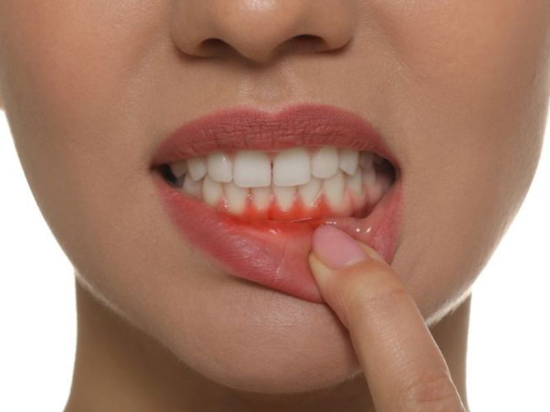 Biểu hiện đau nhức dữ dội sau bọc răng sứ bị nhức