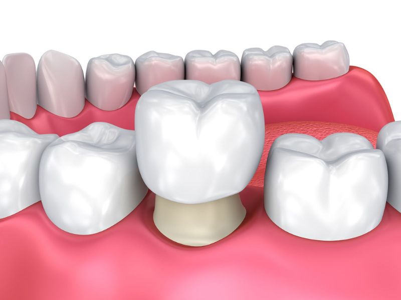 Bọc răng sứ có độ bền cao, với thời gian sử dụng từ 7–15 năm