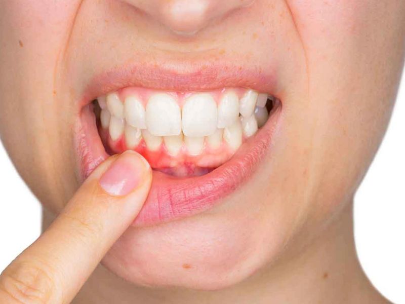Bọc răng sứ không gây tụt lợi nếu được thực hiện đúng kỹ thuật