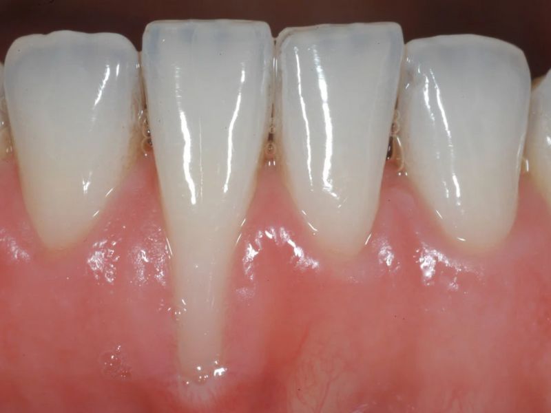 Dấu hiệu nhận biết bọc răng sứ bị tụt lợi - Răng trông dài bất thường