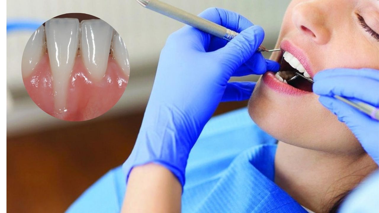 [Giải đáp nhanh] Bọc răng sứ có bị tụt lợi không? 