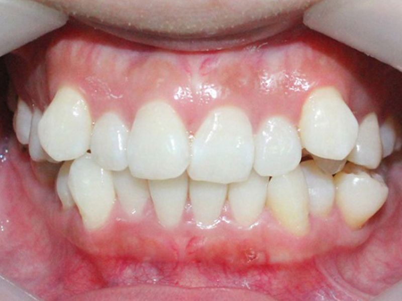 Các trường hợp cần nhổ răng trước khi bọc
