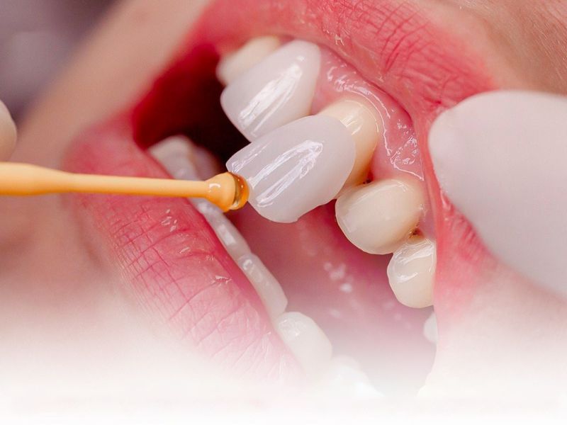 Bọc răng sứ không mài là kỹ thuật phục hình thẩm mỹ hiện đại bằng cách phủ một lớp sứ siêu mỏng cố định lên mặt trước của răng cửa.