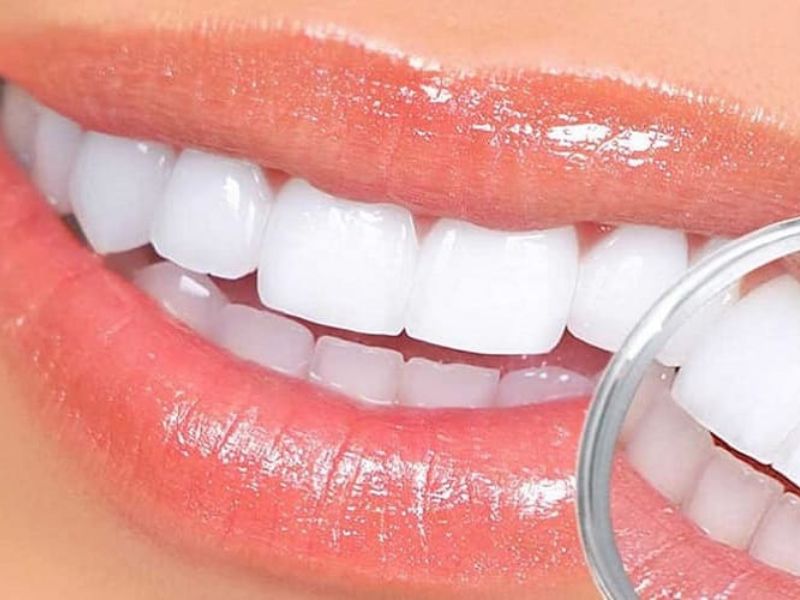 Ưu - nhược điểm khi bọc răng sứ không mài