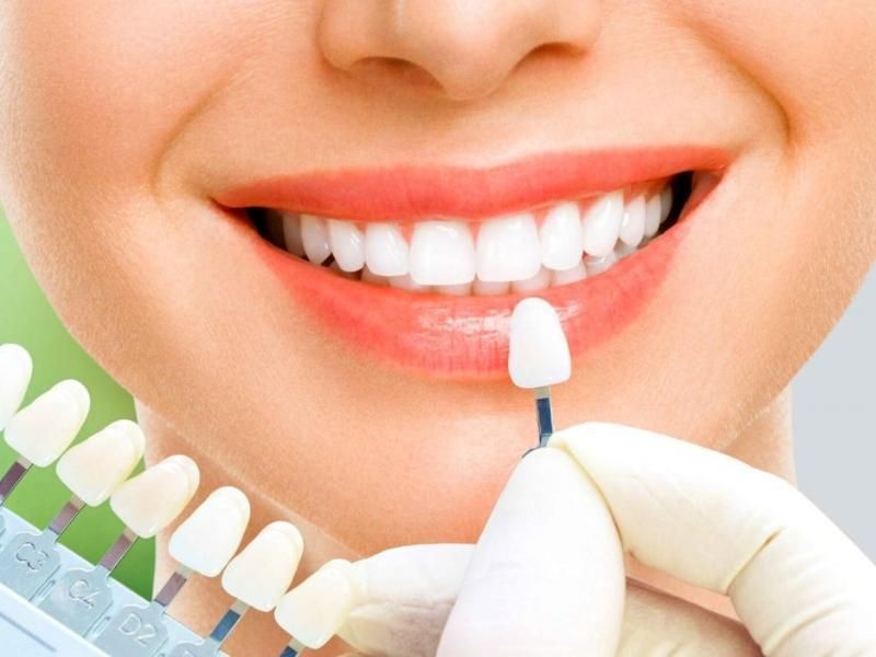 Người có răng khỏe mạnh, muốn cải thiện màu sắc nên bọc răng sứ không mài