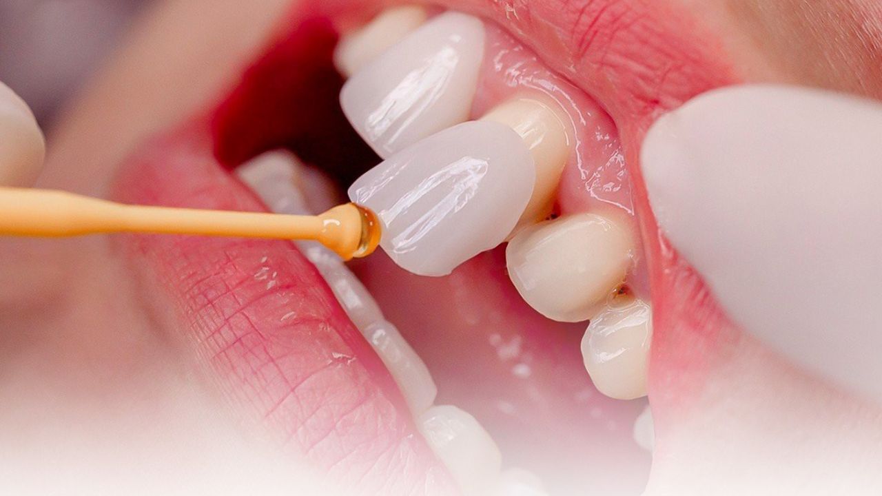 Bọc răng sứ không mài là gì? Ưu – nhược điểm và giá bao nhiêu?