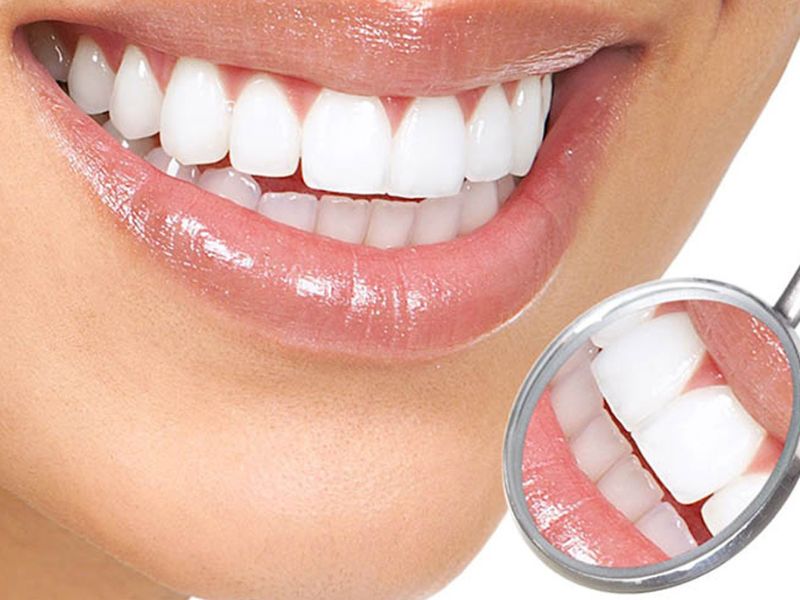 Lưu ý trước khi bọc răng sứ kim loại