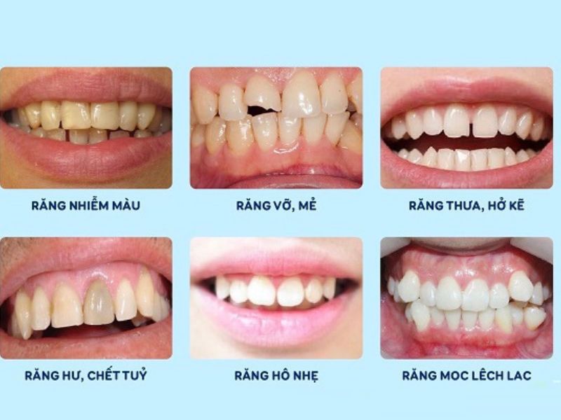 Các đối tượng nên bọc răng sứ kim loại