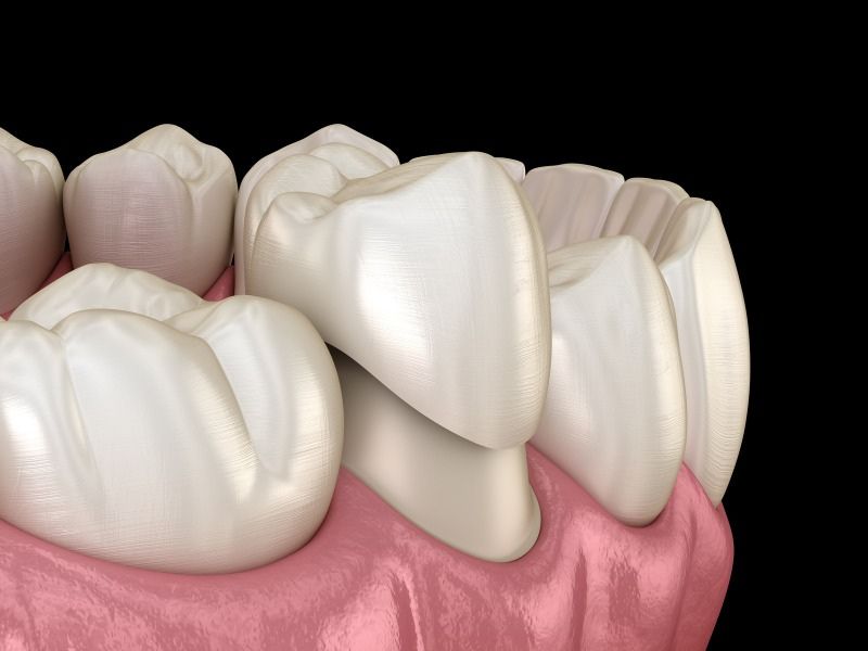 Bọc răng sứ lần 2 là quá trình tháo bảo mão răng sứ cũ thay thế bằng mão sứ mới