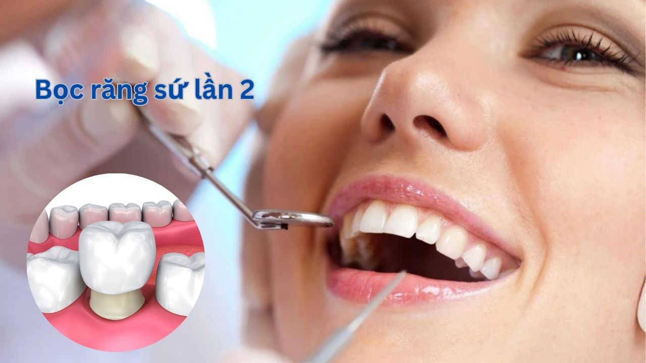 Bọc răng sứ lần 2 khi nào? Dấu hiệu nhận biết