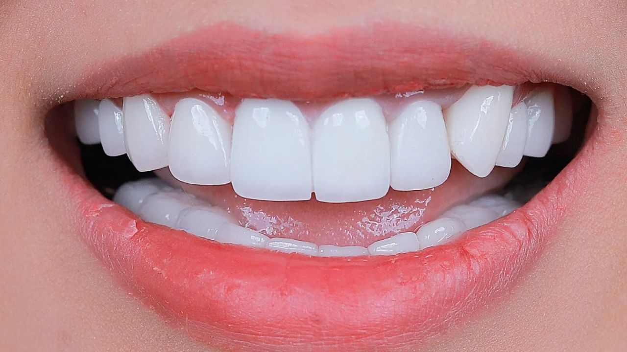 Cách nhận biết răng sứ Zirconia chính hãng, chất lượng