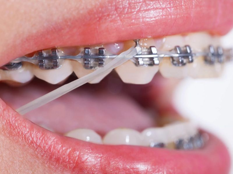 Chun niềng răng là dây cao su chuyên dụng có nhiều tên gọi khác như thun niềng răng, thun chỉnh nha