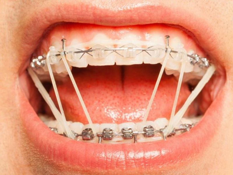 Chun niềng răng có tác dụng tạo lực kéo ổn định, hỗ trợ quá trình di chuyển răng và điều chỉnh khớp cắn