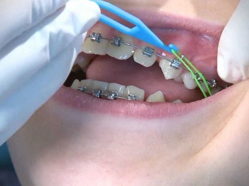 Dùng chun niềng răng có gây cảm giác đau hoặc ê nhẹ, đặc biệt trong 2-3 ngày đầu