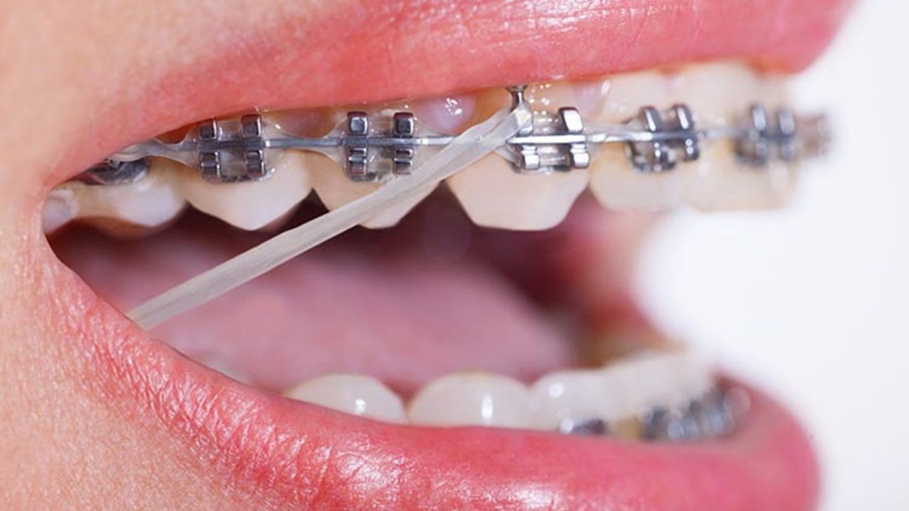 Chun niềng răng là gì? Dùng chun niềng răng có đau không?