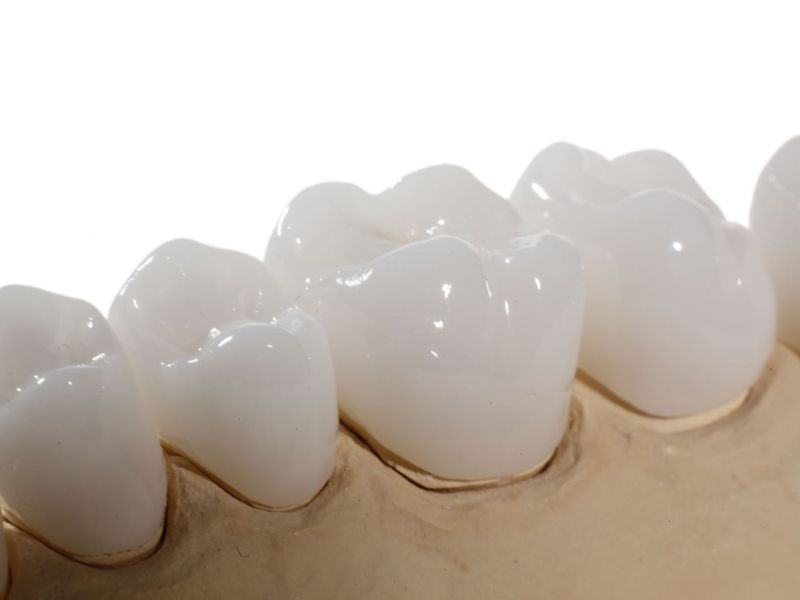 Răng sứ Venus là dòng răng toàn sứ cao cấp của Đức, có màu trắng trong tự nhiên