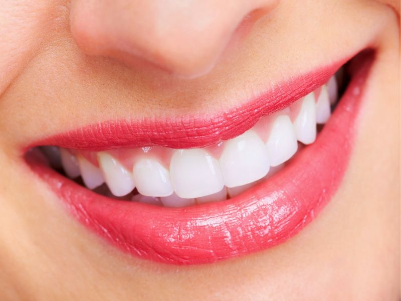 Răng sứ Venus có chi phí hợp lý, màu sắc tự nhiên , vẫn đảm bảo độ bền và tính thẩm mỹ
