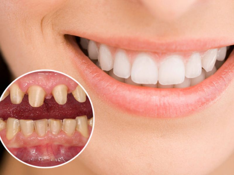 Nên bọc răng sứ Venus vì sử dụng 100% phôi sứ nguyên chất, có độ bền và khả năng chịu lực tốt