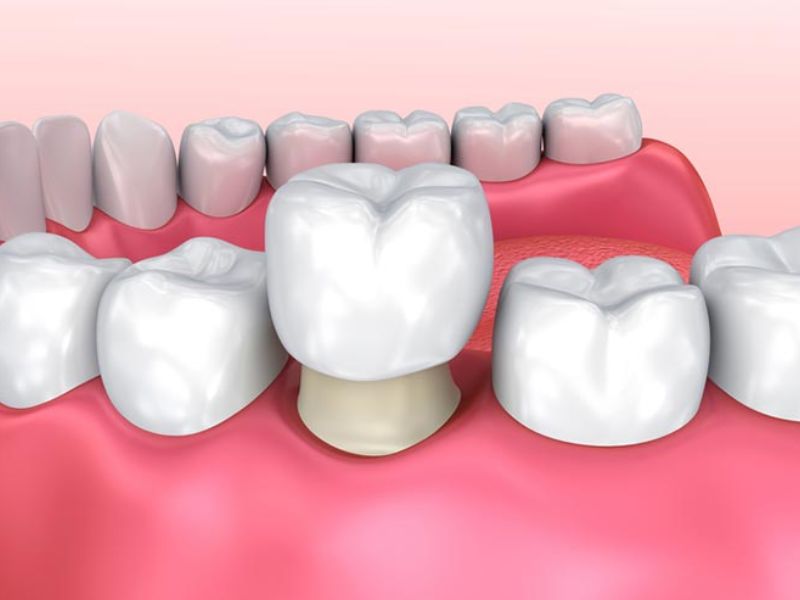 Nên trồng răng sứ vì đây là giải pháp hiện đại giúp khôi phục khả năng nhai, có tính thẩm mỹ cao, độ bền từ 5-15 năm