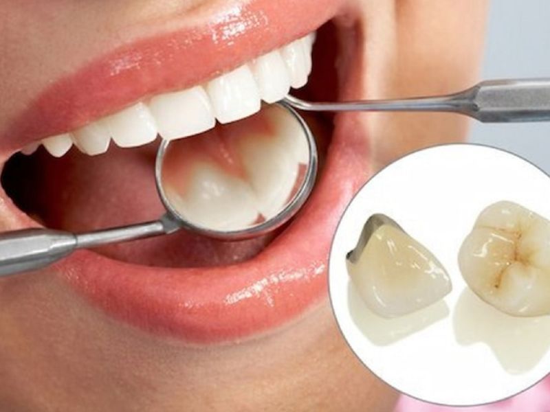 Trồng răng sứ không gây đau nhờ kỹ thuật hiện đại và được gây tê tại chỗ khi thực hiện