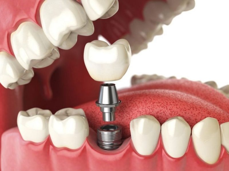 Trồng răng Implant nên được thực hiện khi mất một răng, nhiều răng hoặc mất răng toàn hàm