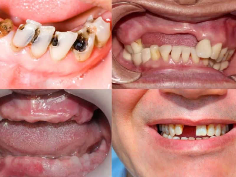Các đối tượng nên trồng răng Implant 