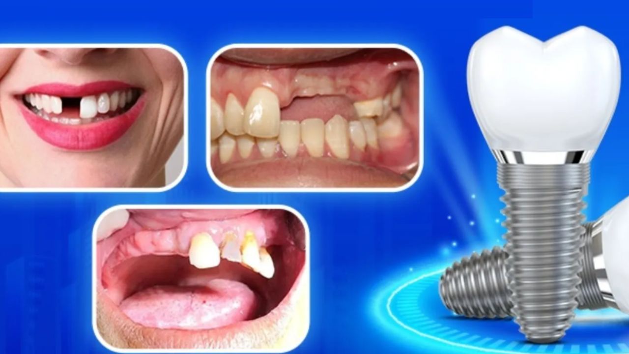  Khi nào thì nên trồng răng Implant – Thời điểm cấy Implant hiệu quả