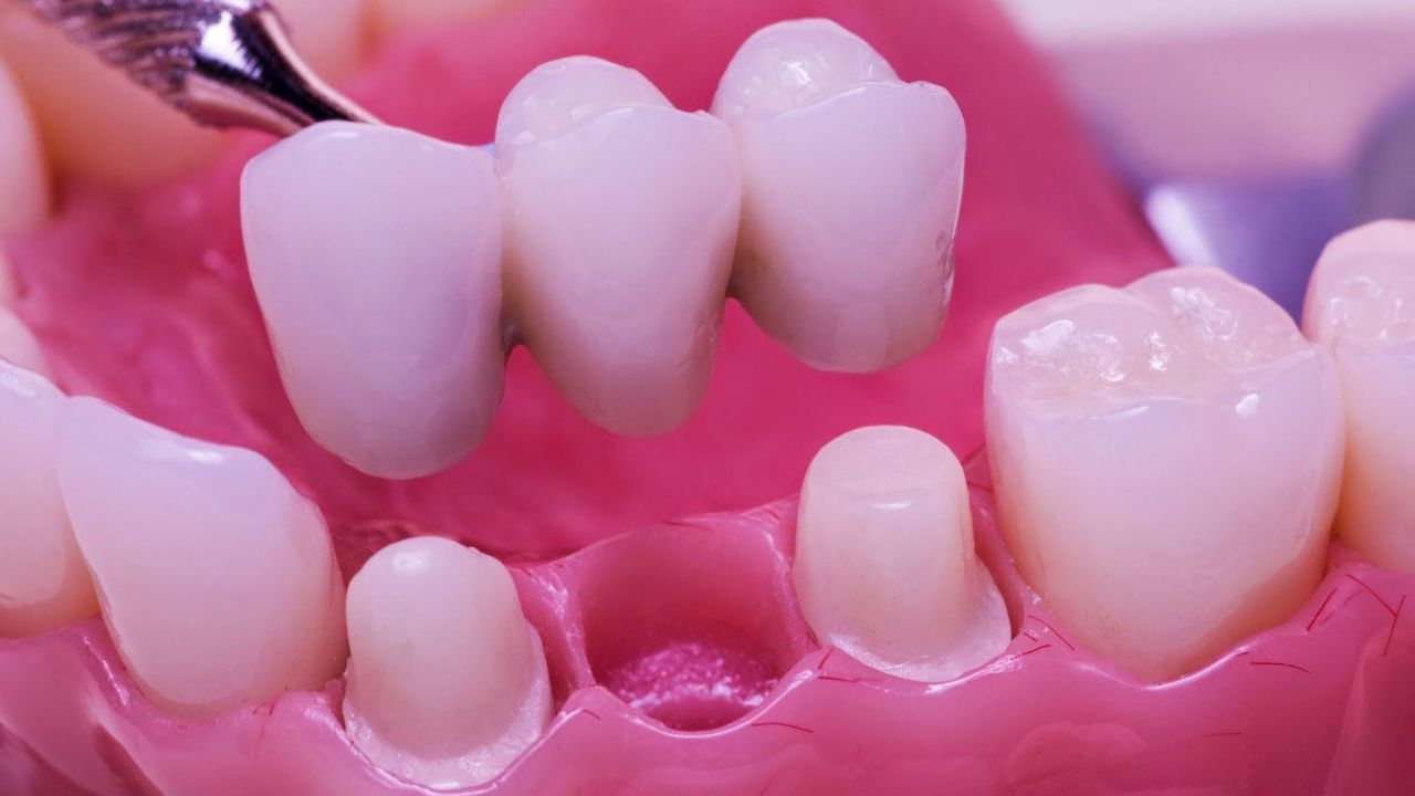 Làm cầu răng sứ giá bao nhiêu? Yếu tố ảnh hưởng chi phí