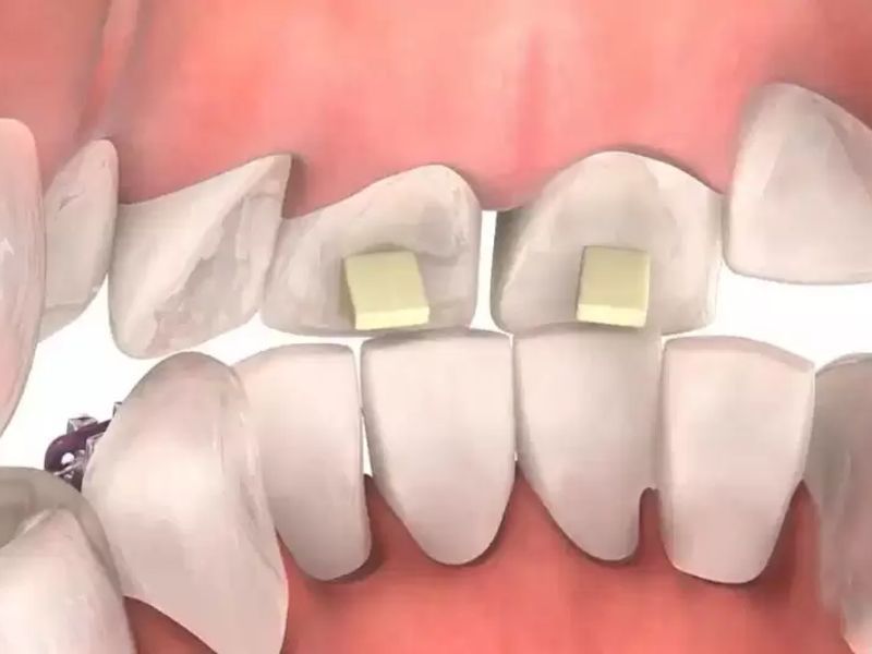 Nâng khớp cắn sử dụng các vật liệu như miếng nâng khớp, composite hoặc khối nhựa để tạo ra khoảng cách tạm thời giữa hai hàm răng