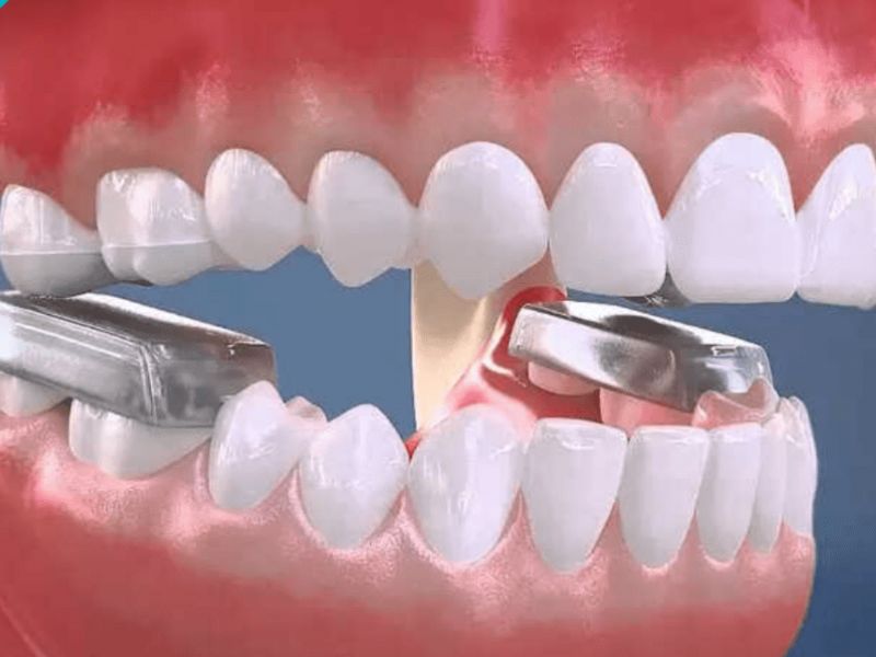 Nâng khớp cắn thường được chỉ định các sai lệch khớp cắn sâu, khớp cắn hở, cắn chéo hoặc răng sai khớp. 