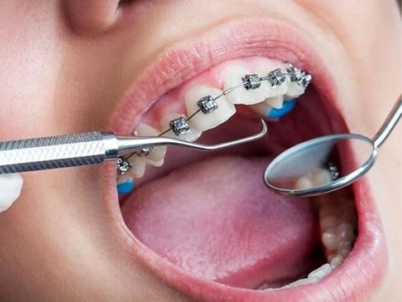 Nâng khớp cắn khi niềng răng không gây đau nhức nếu thực hiện đúng kỹ thuật