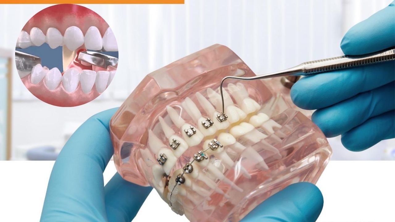 Nâng khớp cắn niềng răng có đau không? mất bao lâu?