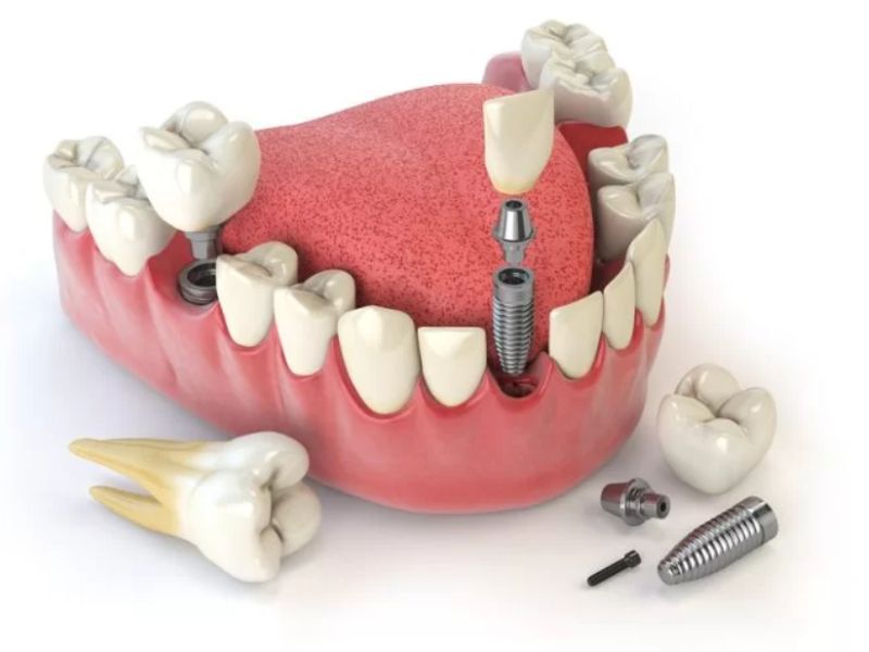 Trồng răng sớm sau nhổ giúp ngăn ngừa tiêu xương hàm, giữ ổn định khớp cắn, đảm bảo chức ăn nhai