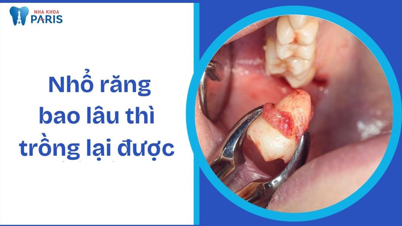Nhổ răng bao lâu mới trồng lại được?  Cần lưu ý gì?