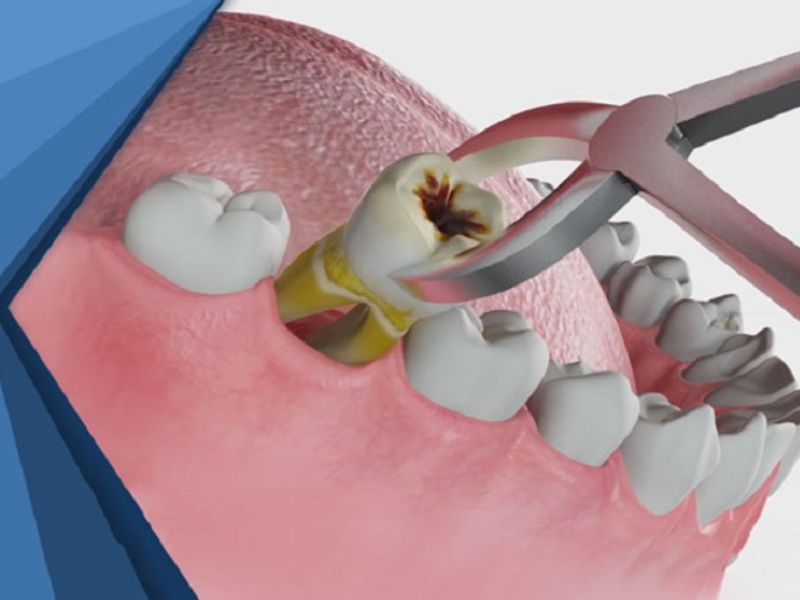 Nhổ răng cấm không trồng lại có thể gây ra nhiều biến chứng nguy hiểm